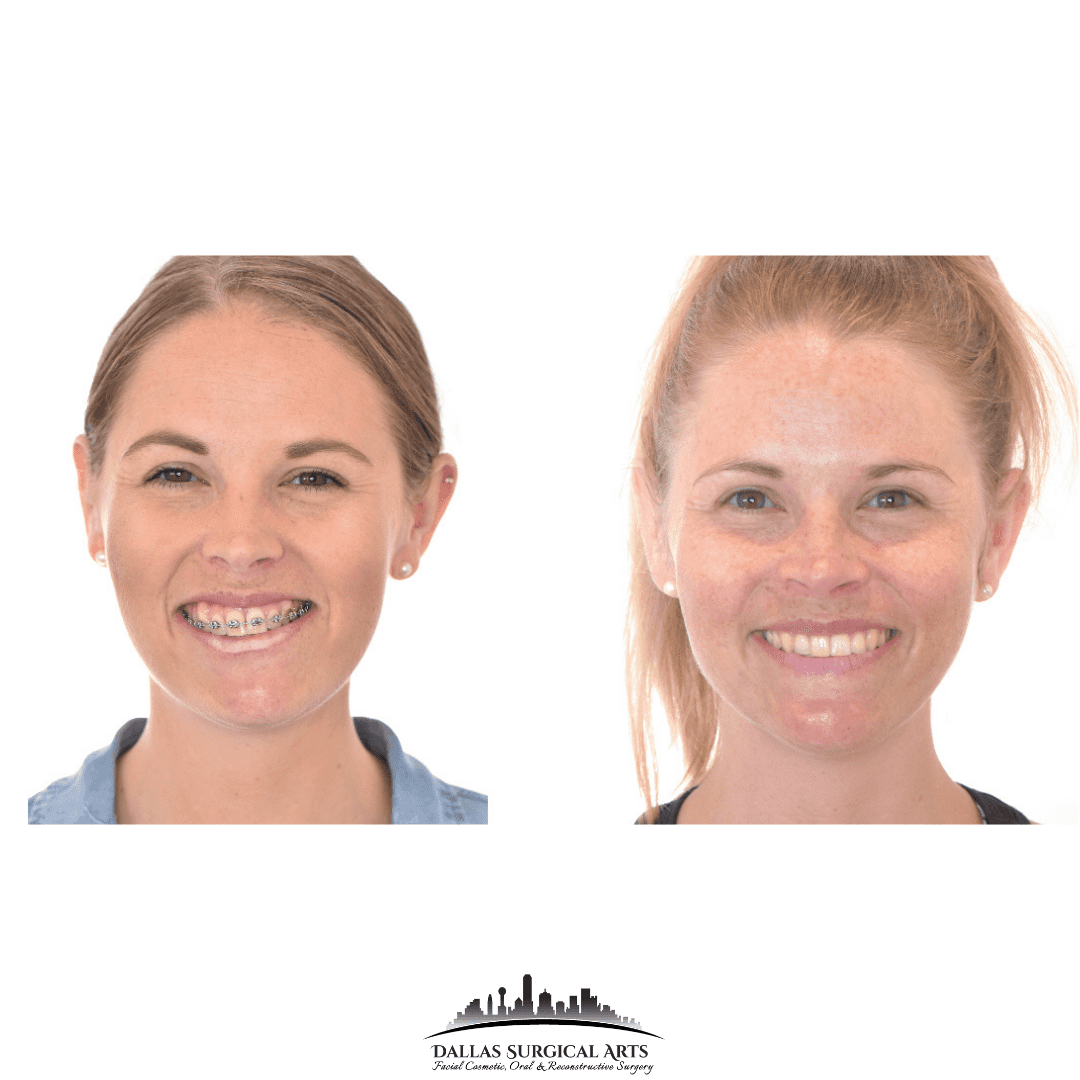 Tmj Surgery Dallas Oral Surgery