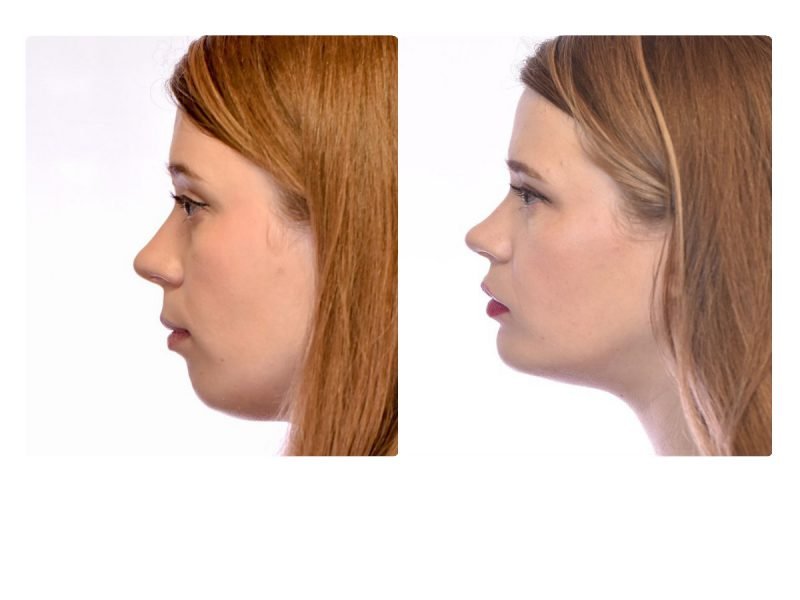 Can Jaw Surgery Correct Sleep Apnea