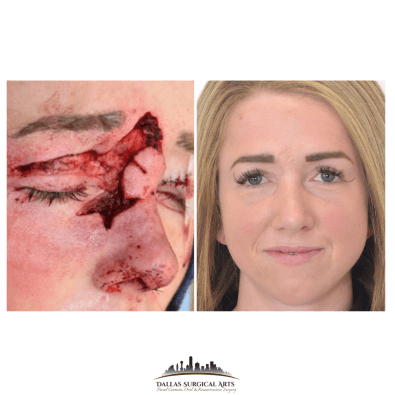 before and after trauma surgery