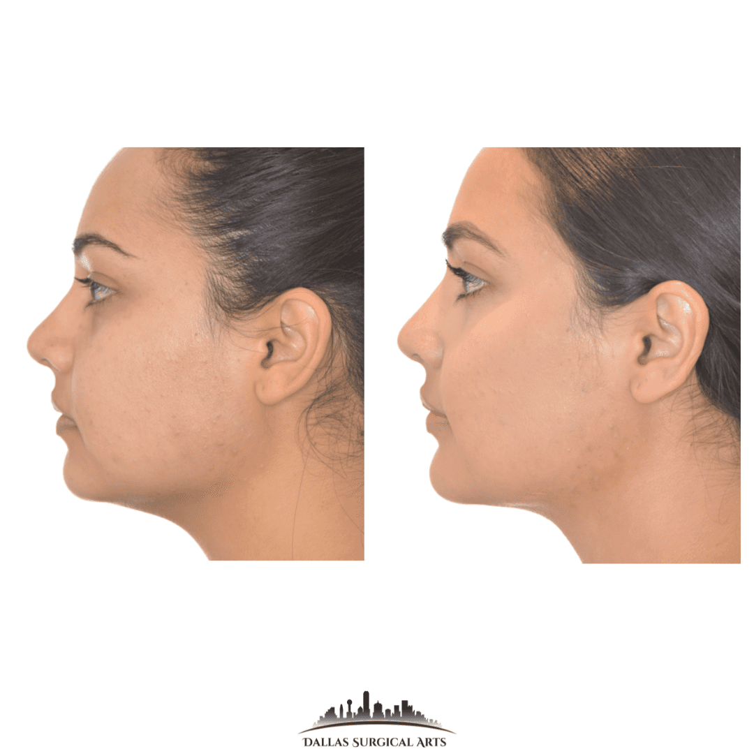 Buccal Fat Removal | Dallas Oral Surgery