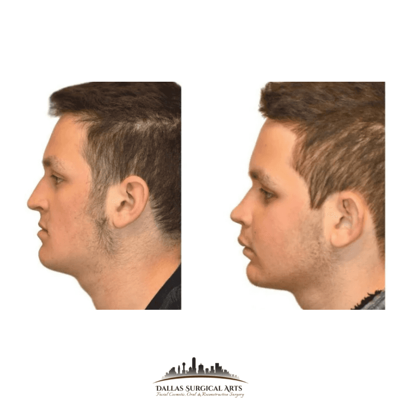 Jaw Repositioning (Orthognathic Surgery) | Dallas Surgical Arts