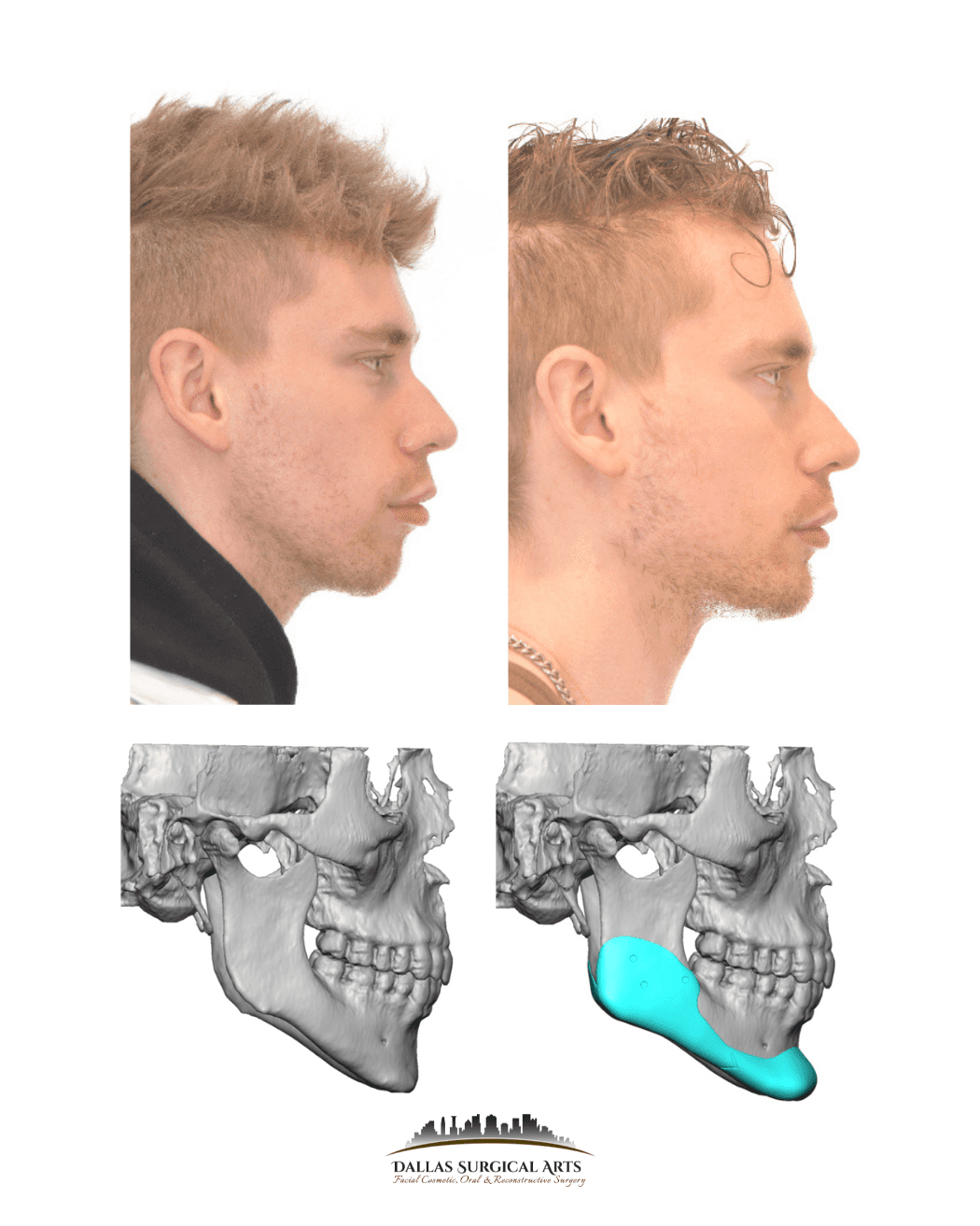 Dr. Randy Sanovich Surgical Jawline Contouring Jawbone Shaving, V