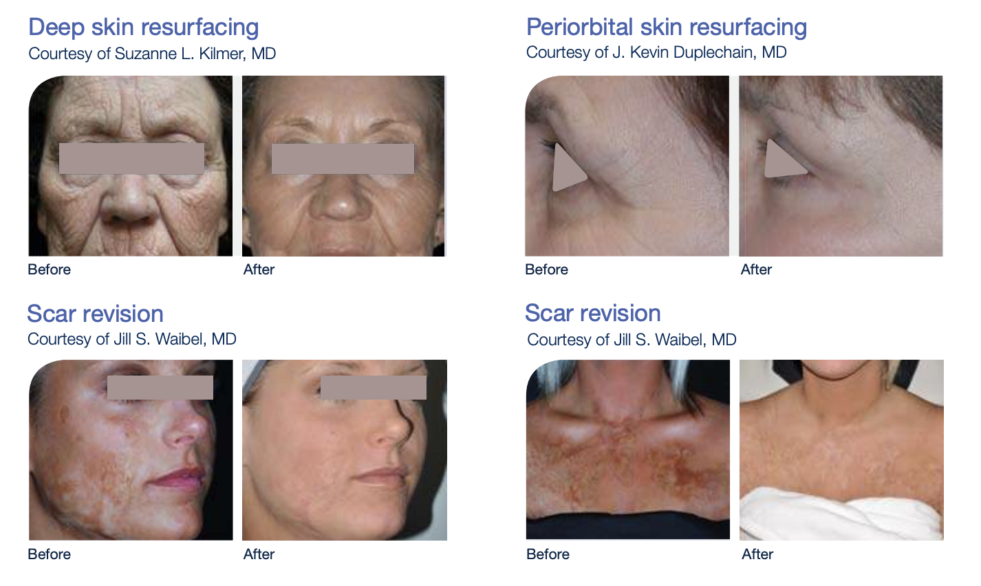 🥇 NYC Face Laser Skin Resurfacing